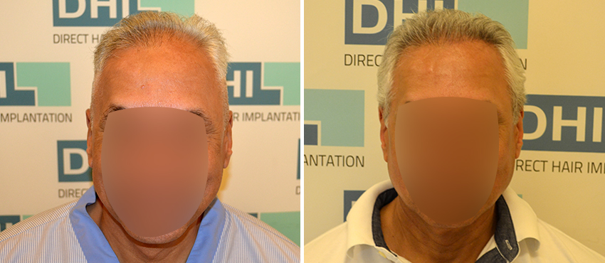 DHI before & after hair transplant results